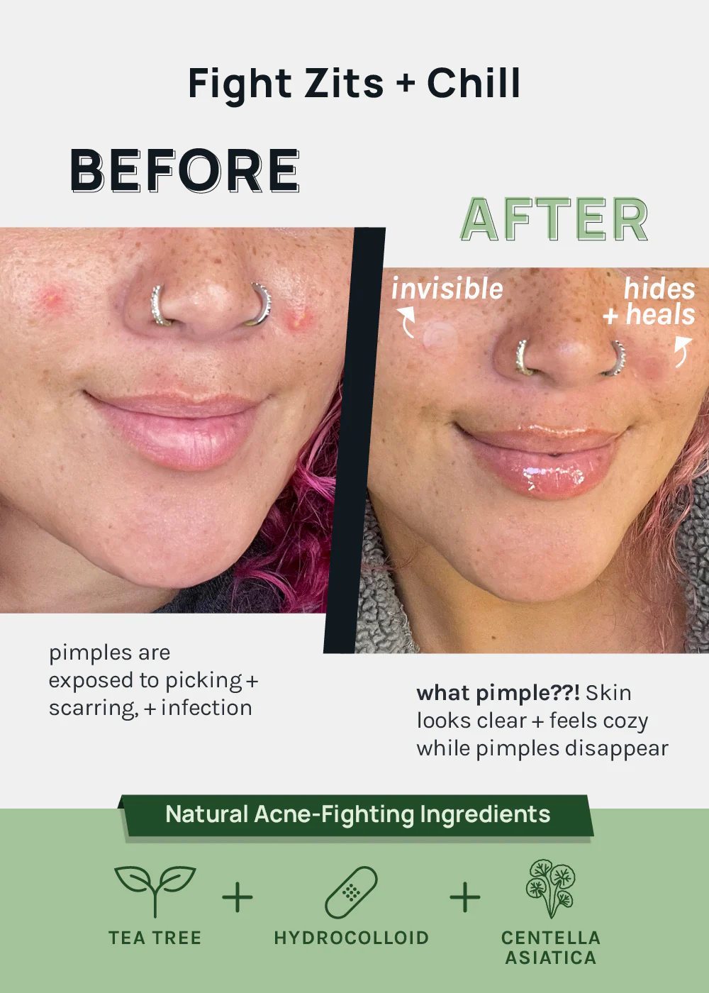 AOA Skin Invisible Acne Patches - Image 3